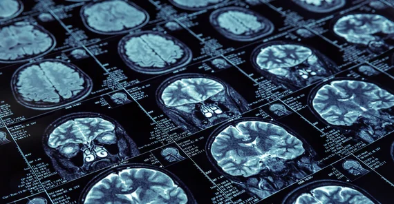 MRT-Scan eines Gehirns. Foto: Fotolia.com/Nomad_Soul.