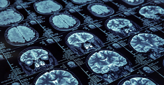 MRT Scan from a brain. Photo: Fotolia.com/Nomad_Soul.