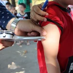 Measurement of triceps skinfold thickness