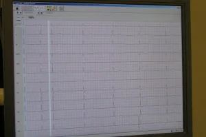 Ausdruck eines EKGs