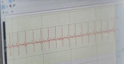 ECG curve
