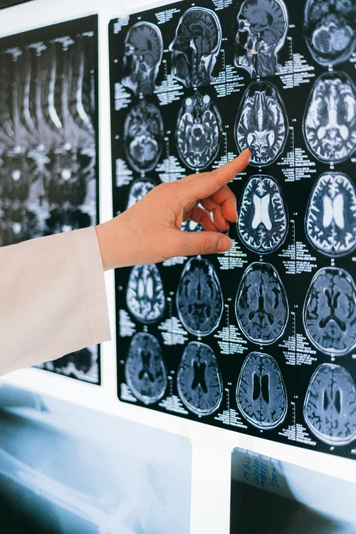 MRT-Aufnahme von einem Patienten mit Alzheimer.