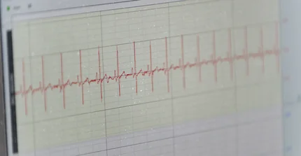 EKG-Kurve